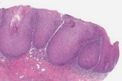 Well differentiated squamous cell carcinoma of the tongue