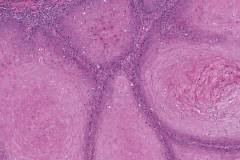 Well differentiated squamous cell carcinoma of the tongue