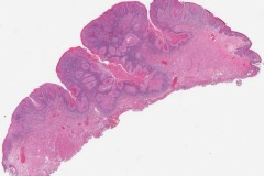 Well differentiated squamous cell carcinoma of the tongue