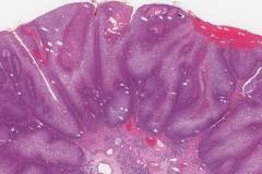 Well differentiated squamous cell carcinoma arising in the floor of mouth