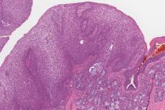 Well differentiated squamous cell carcinoma arising in the floor of mouth