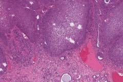 Well differentiated squamous cell carcinoma arising in the floor of mouth