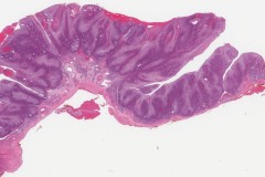 Well differentiated squamous cell carcinoma arising in the floor of mouth