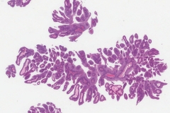 Squamous papilloma of the oropharynx