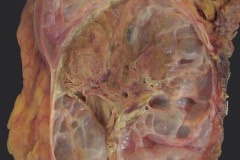 Metastatic teratoma compressing the kidney