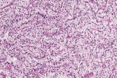 TFE3-rearranged renal cell carcinoma