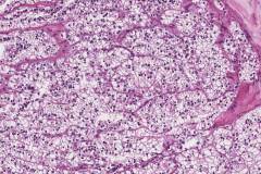 TFE3-rearranged renal cell carcinoma