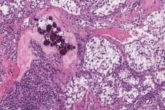 TFE3-rearranged renal cell carcinoma