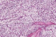 TFE3-rearranged renal cell carcinoma