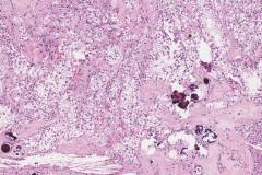 TFE3-rearranged renal cell carcinoma