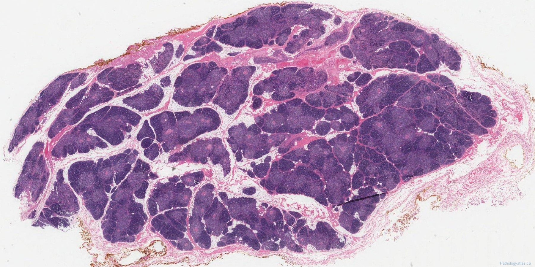 Thymic hyperplasia Atlas of Pathology