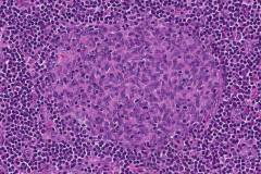 Thymoma type A