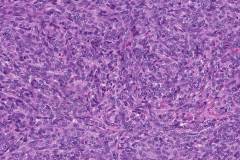 Thymoma type A