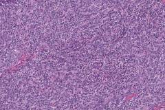 Thymoma type AB