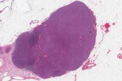 Thymoma type AB