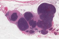 Thymoma type B1