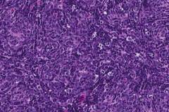 Thymoma type B1