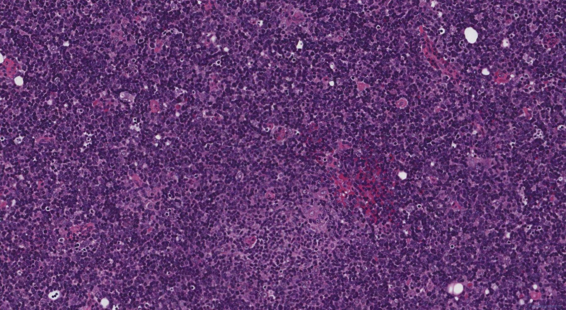 Thymoma Type B1 | Atlas Of Pathology