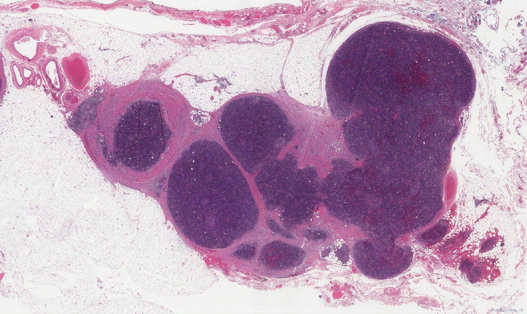 Thymoma Type B1 | Atlas Of Pathology