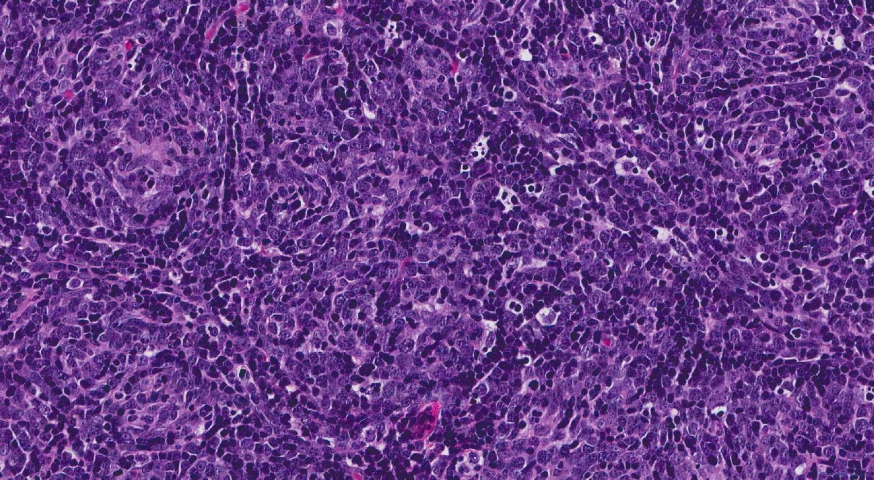 Thymoma Type B1 | Atlas Of Pathology