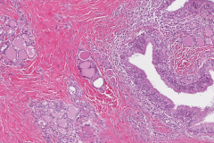 Thyroglossal duct cyst