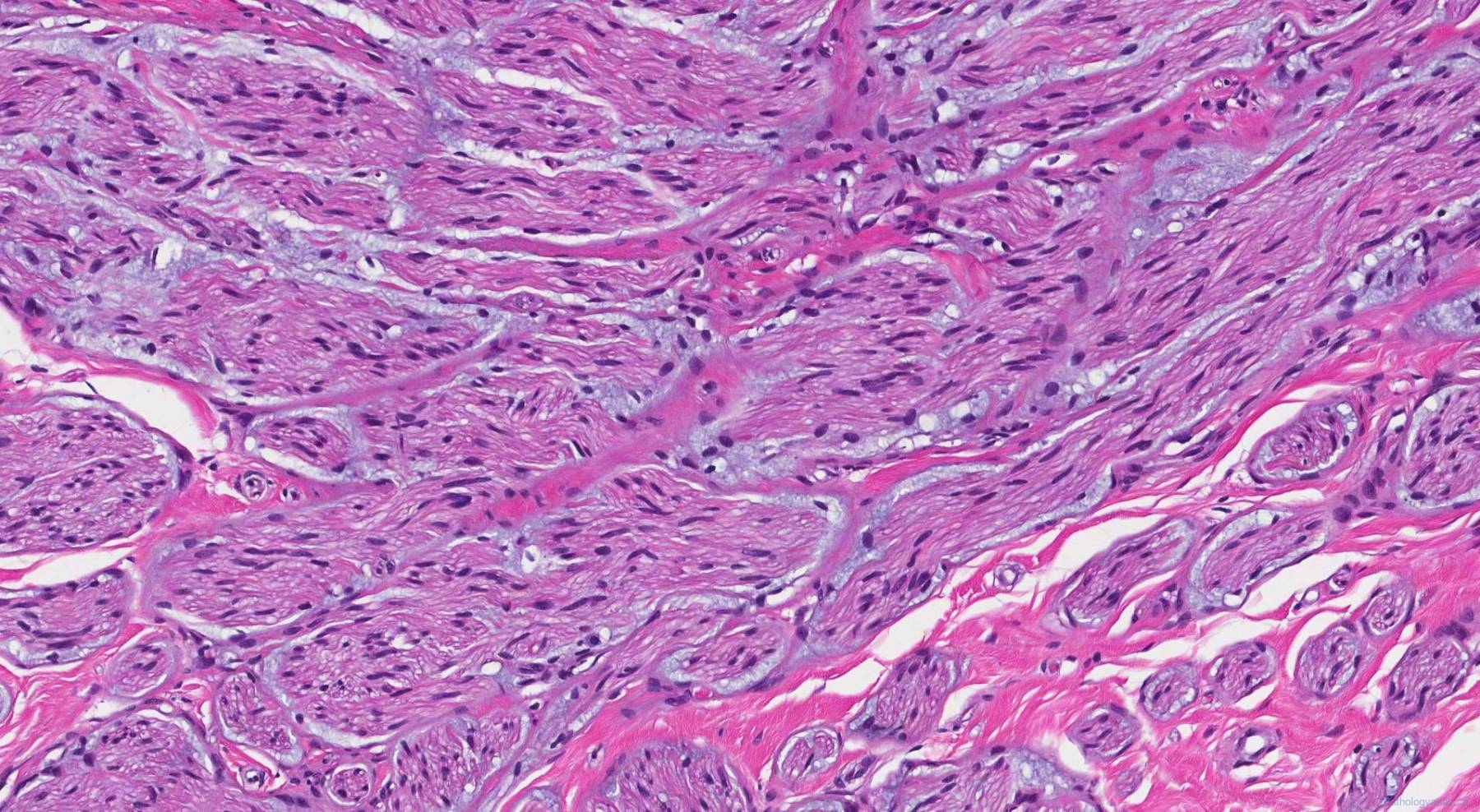 Traumatic neuroma | Atlas of Pathology