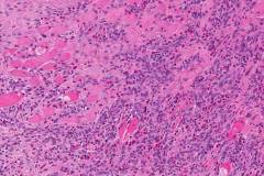 Traumatic ulcerative granuloma with stromal eosinophilia (TUGSE)