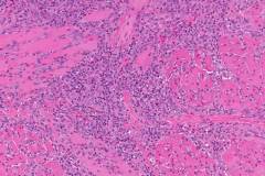 Traumatic ulcerative granuloma with stromal eosinophilia (TUGSE)