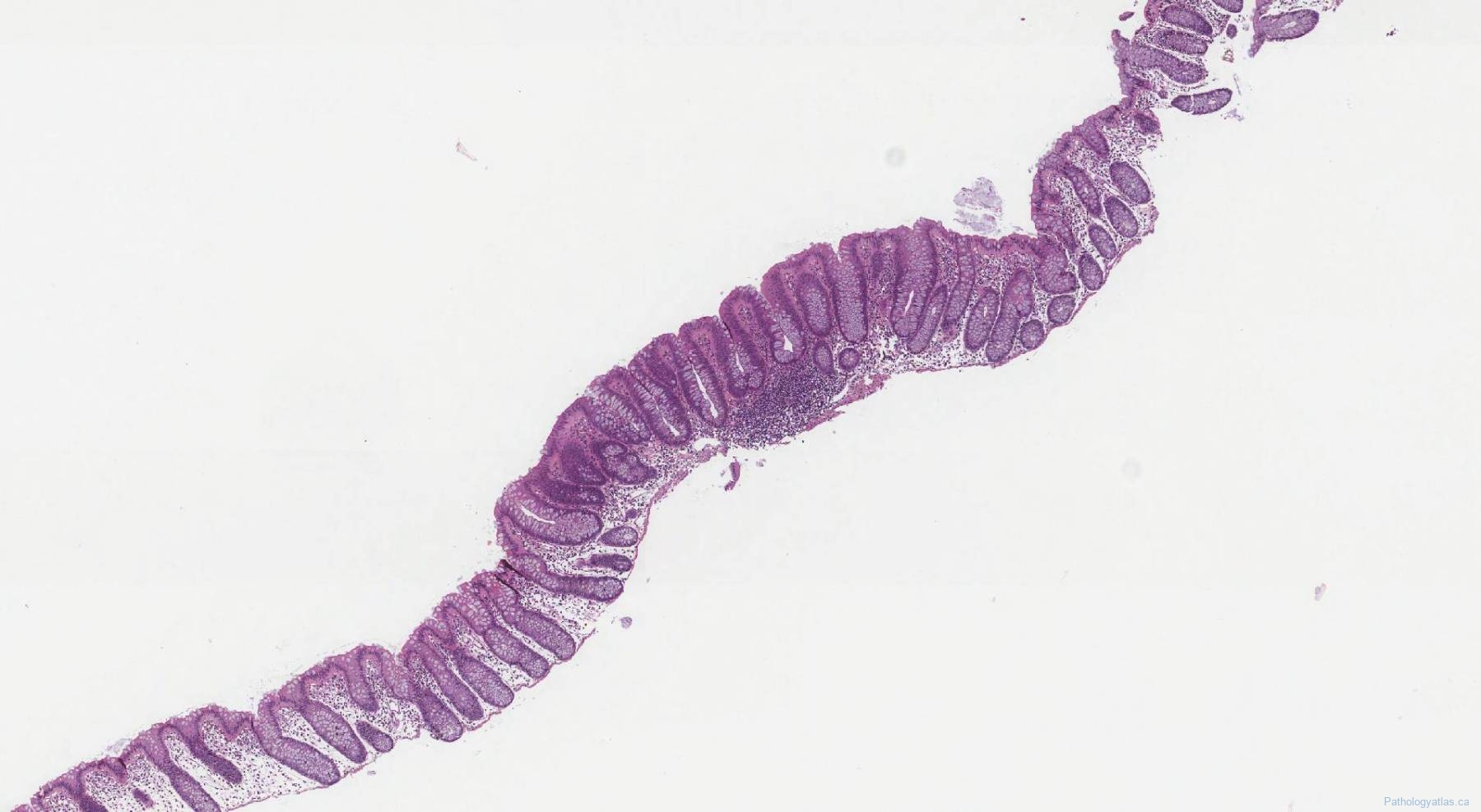 Tubular Adenoma Of The Colon Atlas Of Pathology 5051