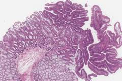 Tubulovillous adenoma and hyperplastic polyp in the rectum