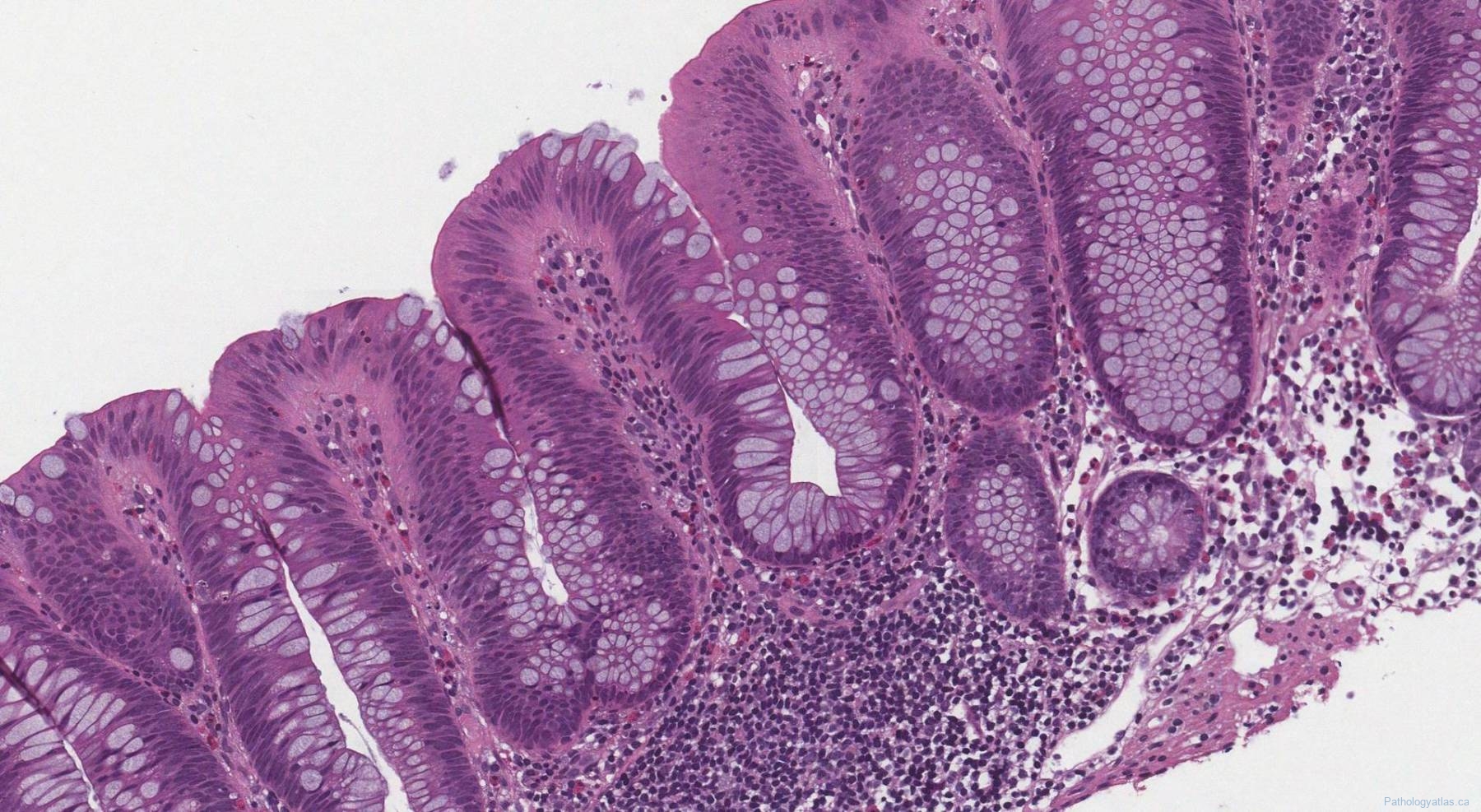 Tubular adenoma of the colon | Atlas of Pathology