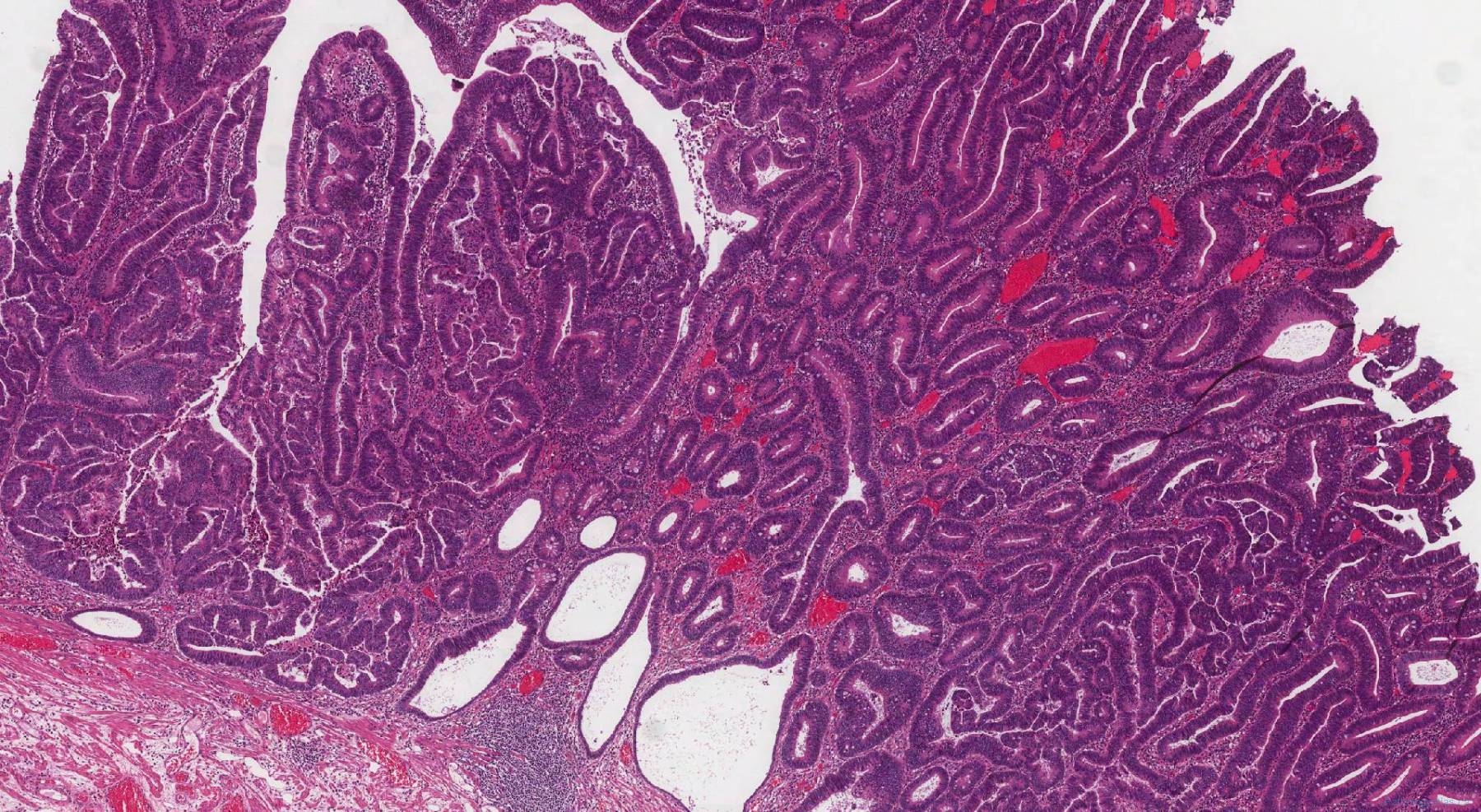 Tubular adenoma of the colon | Atlas of Pathology