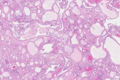 Tubulocystic carcinoma of the kidney