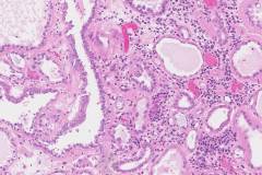 Tubulocystic carcinoma of the kidney