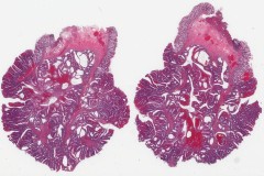 Tubulovillous adenoma of the colon