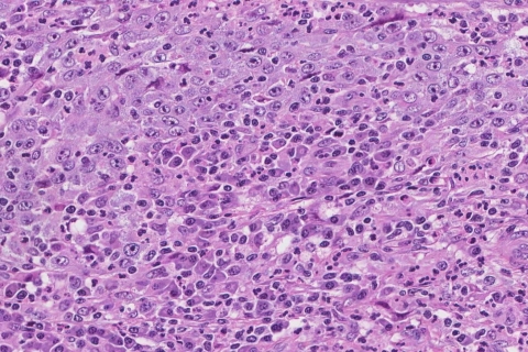 Undifferentiated carcinoma of the uterus | Ottawa Atlas of Pathology