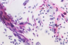 Squamous cell carcinoma