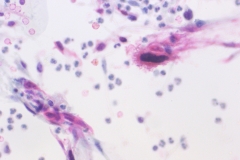 Squamous cell carcinoma