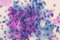 Low-grade squamous intraepithelial lesion (LSIL)