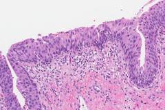 Urothelial carcinoma in situ of the bladder