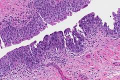 Urothelial carcinoma in situ of the bladder