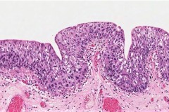 Urothelial carcinoma in situ of the bladder