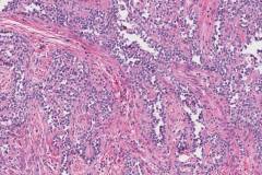 Uterine tumour resembling ovarian sex cord tumour