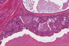 Warthin tumour: Oncocytic cell rich with mucinous metaplasia