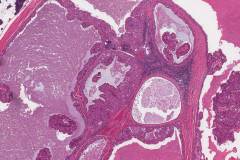 Warthin tumour: Oncocytic cell rich with mucinous metaplasia