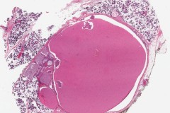 Warthin tumour: Oncocytic cell rich with mucinous metaplasia