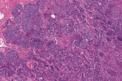 Well differentiated neuroendocrine tumour of the appendix