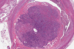 Well differentiated neuroendocrine tumour of the appendix