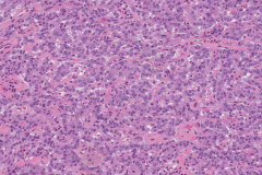 Well differentiated neuroendocrine tumour of the pancreas