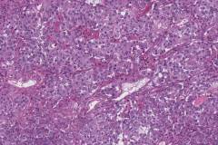 Well differentiated neuroendocrine tumour of the pancreas